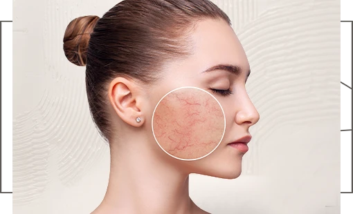 NOON Rosacea Calm nyugtató arckezelés érzékeny, rosaceára hajlamos bőrre